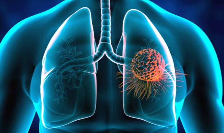 Akciğer kanseri görülme yaşı gittikçe düşüyor