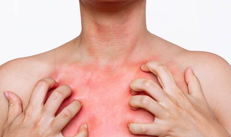 Uzmanından uyuz uyarısı: Bu belirtilere dikkat!