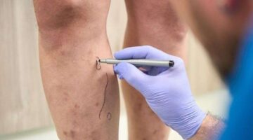 Varis Nedir? Nasıl Tedavi Edilir?